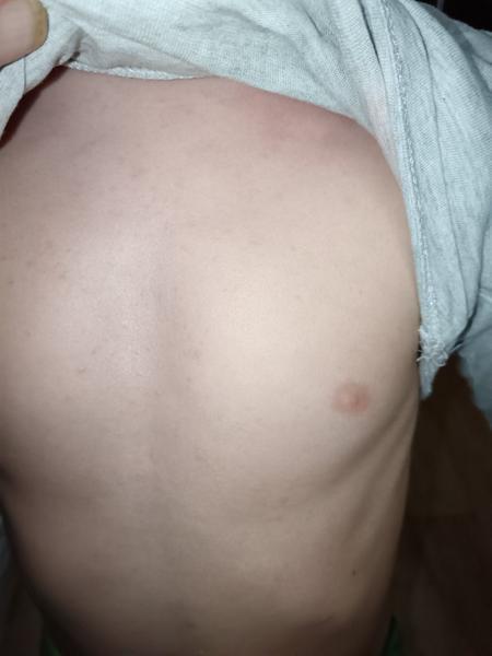 Co může znamenat podobná vyrážka u dítěte?