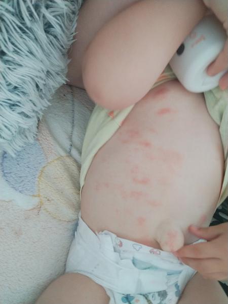 Vyrážka u dítěte na břiše: co pomáhá?