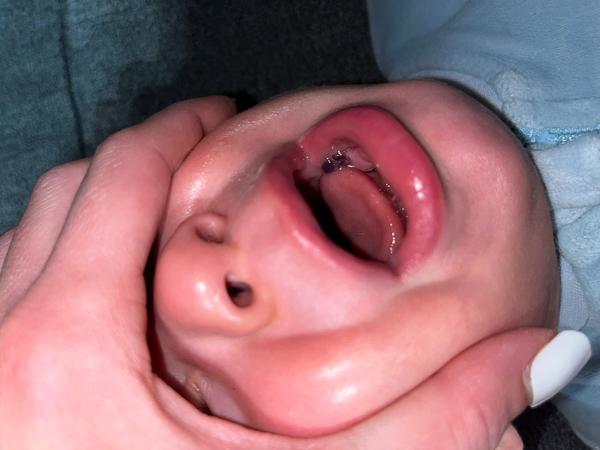 Visící kůže na dásni u dítěte. Čím to může být?