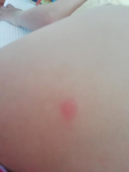 Jsou tohle neštovice?