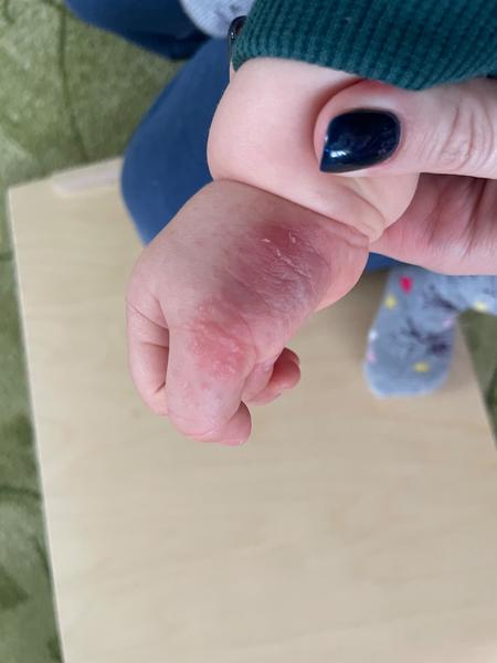 Jak řešit vyrážku u dítěte, pokud mast nepomáhá?