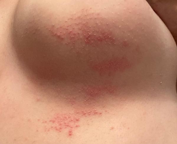 Drobné vyrážky - vředíky. Co by to mohlo být?