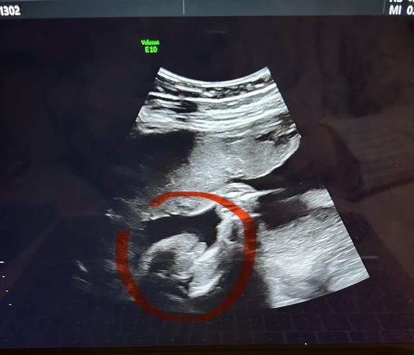 Jak rozpoznat pohlaví dítěte na ultrazvuku?