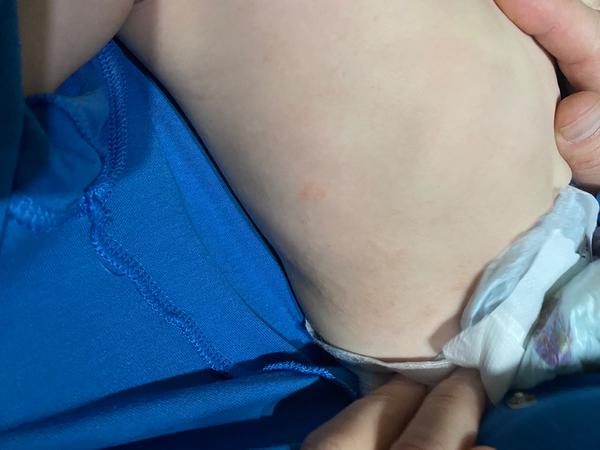 Vyrážka. Co by to mohlo být a jak řešit?