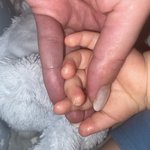 Jak řešit praskání kůže na prstech u dítěte?