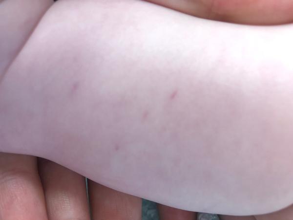 Žilky na nožičce. Co by to mohlo být?