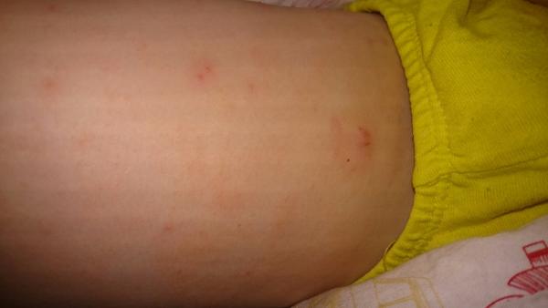 Pupínky na nohou - impetigo?