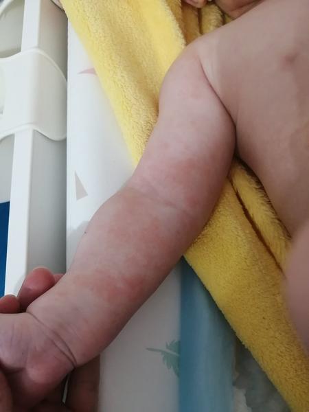 Kojenecký atopický ekzém. Jedná se o něj?