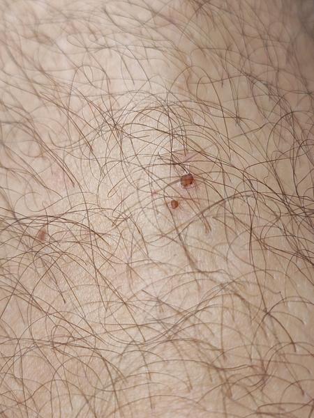 Strupovitá svědivá vyrážka na nohách: svrab nebo kočičí blechy?