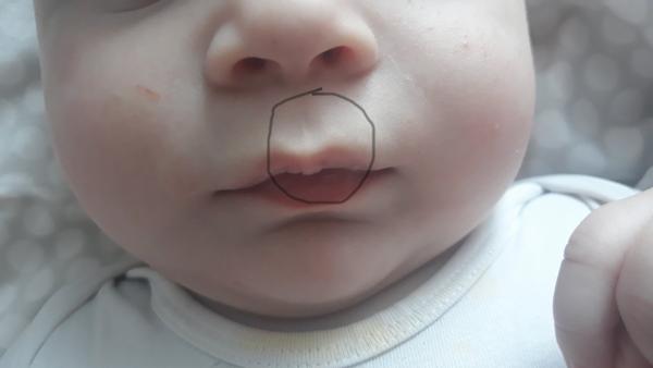 Něco jako jizva nad horním rtem u miminka