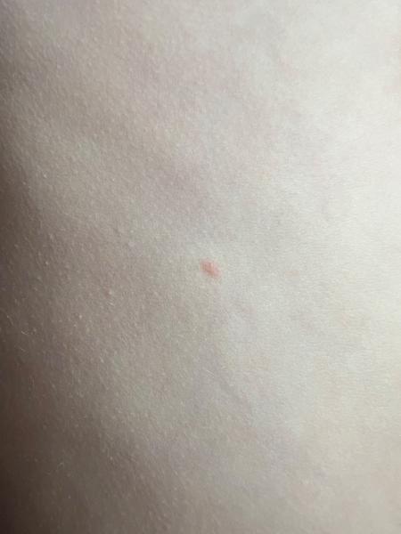 Jedná se o neštovice?