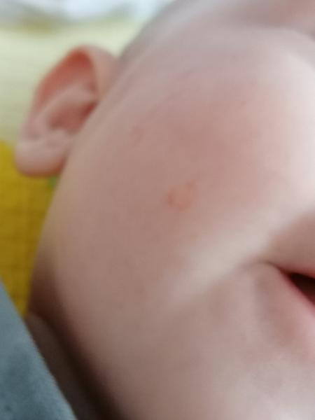 Pupínky na tvářičkách. Neměl někdo něco podobného?