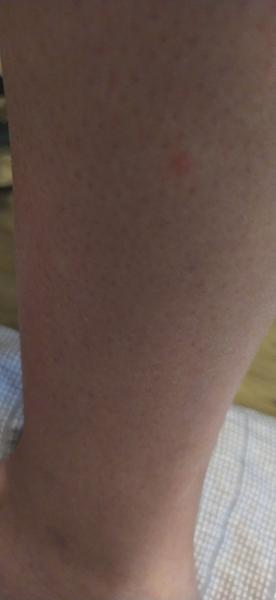 Je svědivý pupínek na noze příznakem něčeho vážného?