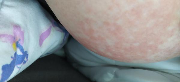 Vyrážka na prsou při kojení