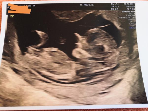 Jak tipnout pohlaví dítěte podle pohlavního hrbolku?