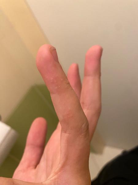 Je to svrab? Jak rozpoznat svrab a co s ním dělat?