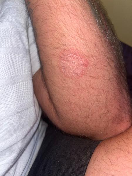 Kožní problém nezastavitelný a nereagující na kortikoidy. Co dělat?