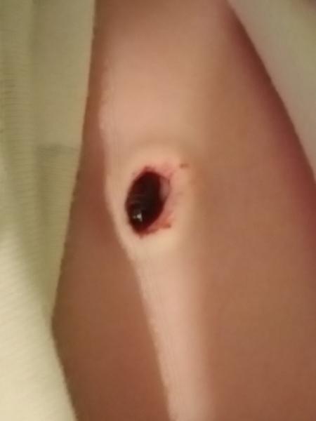 Pupeční kýla. Co s lehkým krvácením?