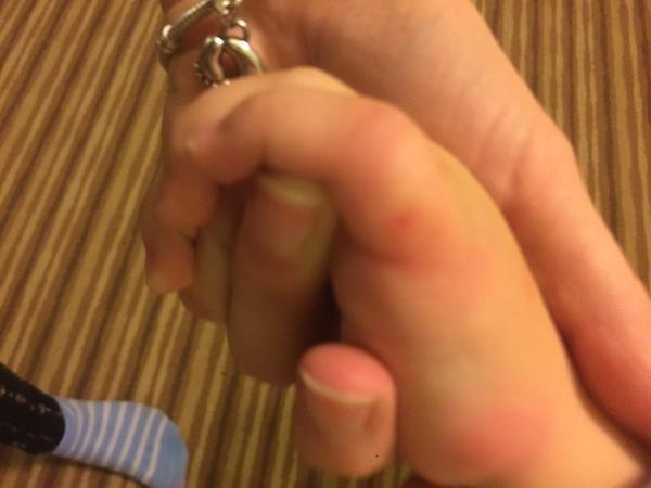 Boulička na ruce u 16měsíčního miminka, co to je?