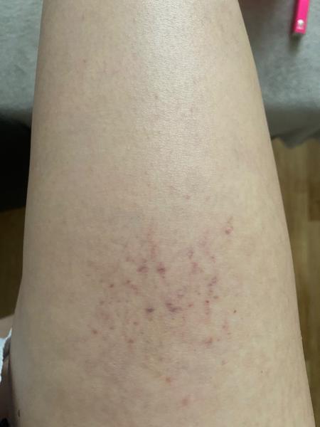 Co jsou červené skvrny na nohou?