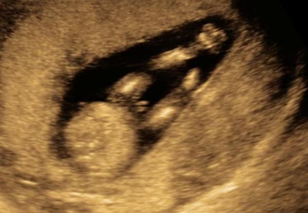 Holčička nebo chlapeček?