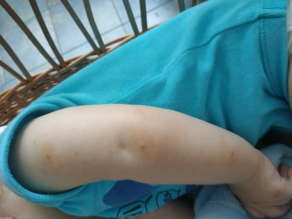 Myslíte, že se může jednat o neštovice?