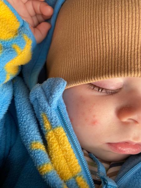 Co může být příčinou vyrážky na tváři šestiměsíčního miminka?