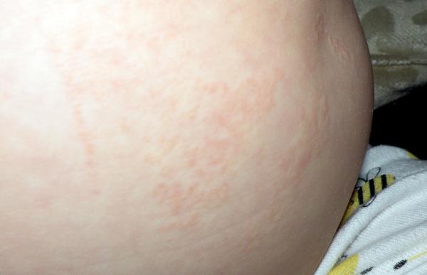 Ekzém/vyrážka, co by zabralo?