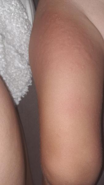 Je to kopřivka nebo něco jiného?