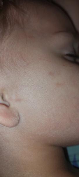 Co způsobuje tmavé fleky na obličeji tříletého dítěte?