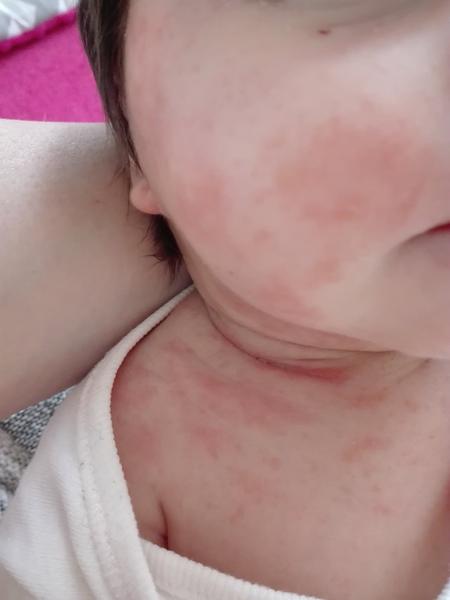 Ekzém nebo je to od pocení?