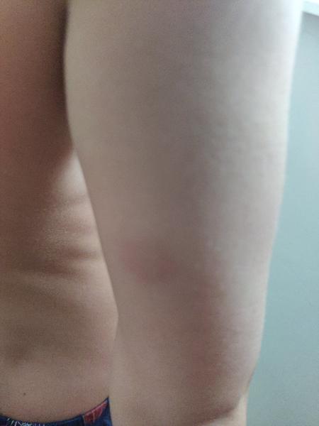 Pupínky u školkového dítěte. Co to může být?