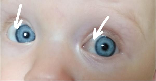 Červený flíček nad okem. Co to je?