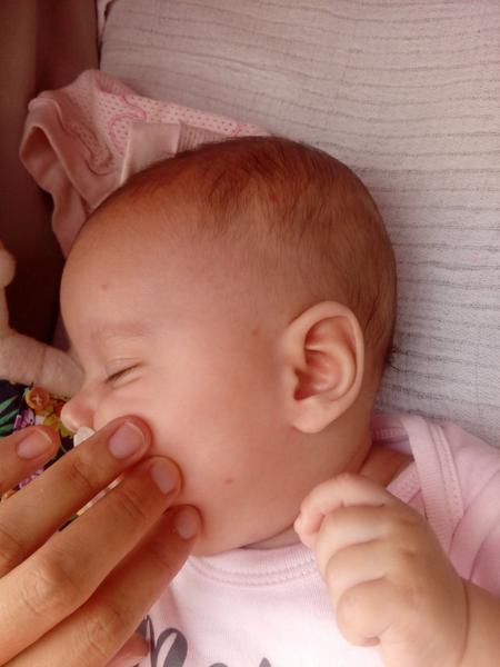 Červené pupínky na obličeji, ve vlasech a jeden na ručičce