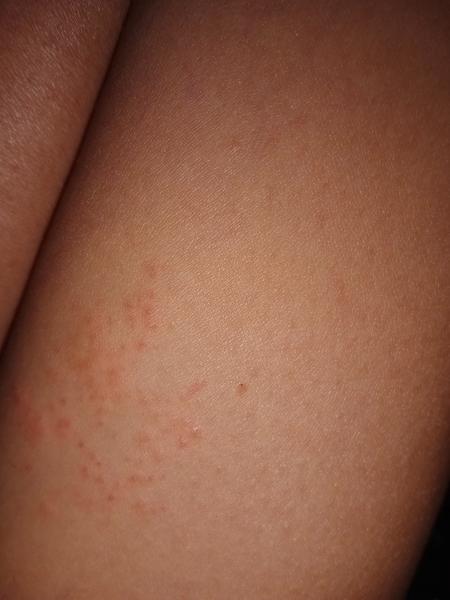 Je to vyrážka nebo ekzém na stehně?