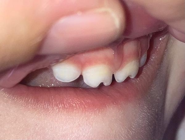 Ostré mléčné zuby u dvouleté dcery. Jak řešit?