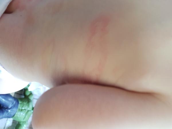 Vyrážka. Co by to mohlo být?