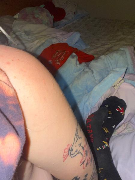 Svědivé pupínky na těle. Jsou to symptomy svrabu?