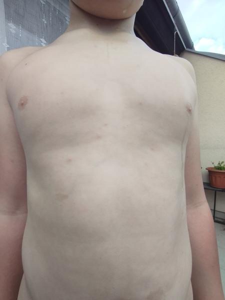 Jsou to příznaky neštovic? Jak to poznat u dětí?