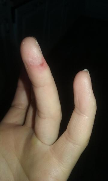 Bolestivé a svědivé prsty: Co způsobuje vyrážku?