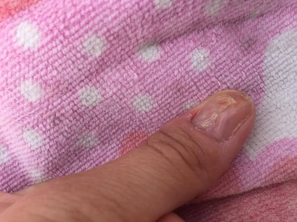 Plíseň nehtu nebo deformace po trhání?