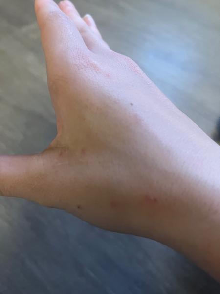 Jak řešit svědění a vyrážku na těle?