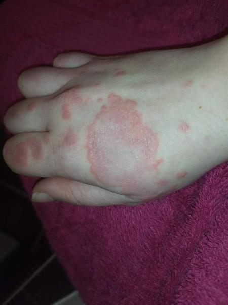 Červený flek na ruce: Co způsobuje zhoršování?