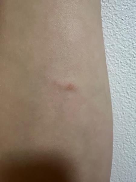 Pasový opar v těhotenství. Jaké jsou příznaky a rizika?