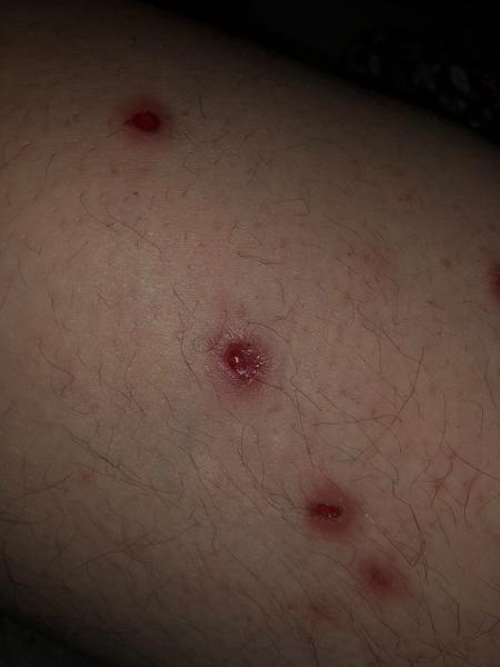 Příčiny červených pupínků na stehnech. Co je způsobuje?