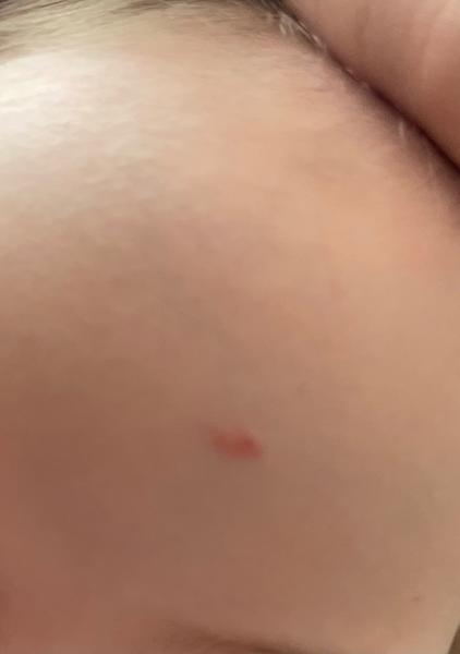 Co znamenají suché tečky po těle dítěte?