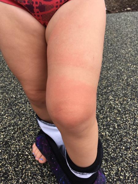 Fleky na noze. Mohla by to být borelióza? Nebo spíše alergie?