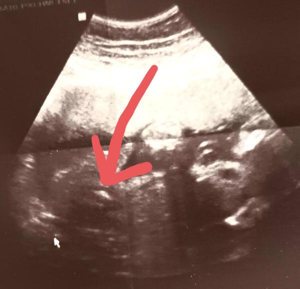 Poznáte pohlaví dítěte z této ultrazvukové fotky?