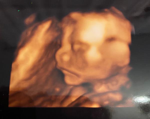 Možnost určení pohlaví miminka z 3D ultrazvuku?