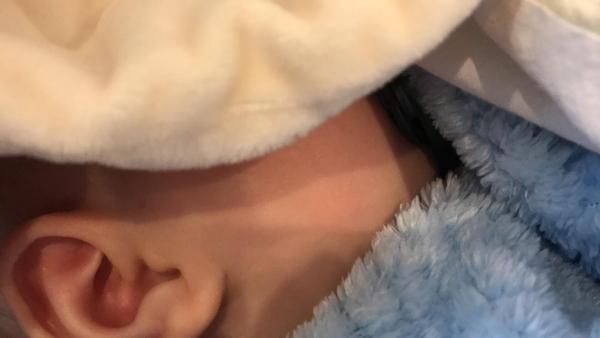 Ekzém či kvasinka?